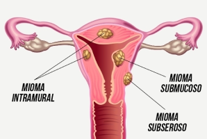 mioma miomatose menstruacao